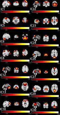 Effect of Impaired Stereoscopic Vision on Large-Scale Resting-State Functional Network Connectivity in Comitant Exotropia Patients